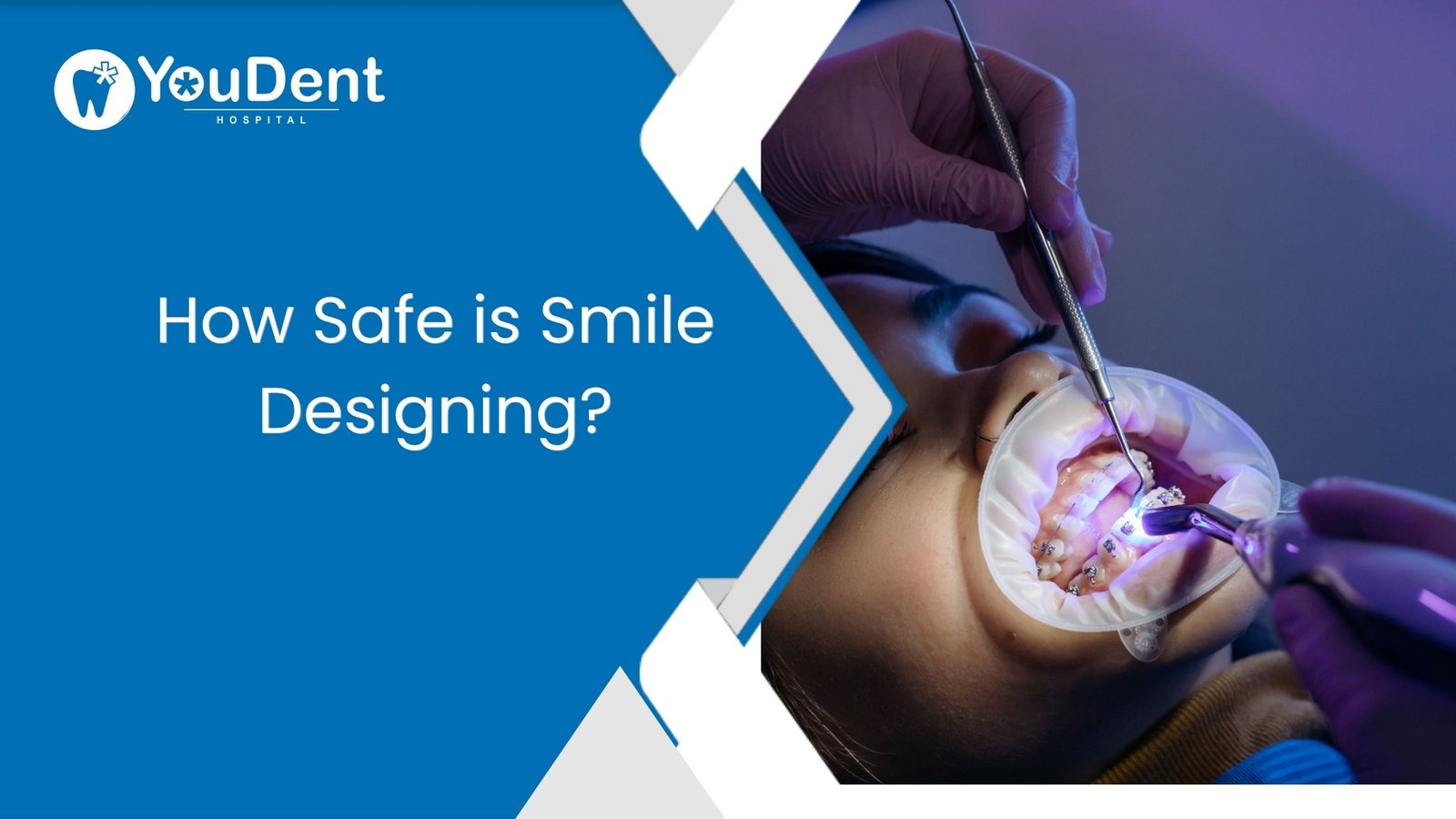 How Safe is Smile Designing?