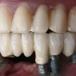 Ultimate Guide to Dental Implants