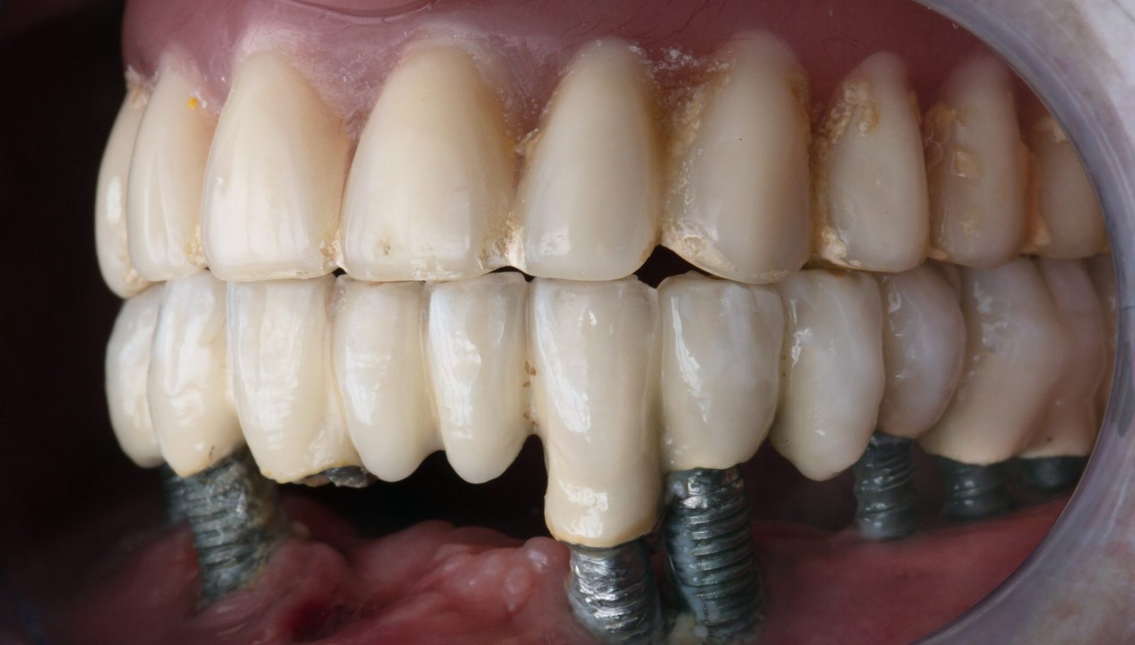 Ultimate Guide to Dental Implants